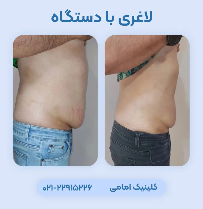 لاغری موضعی با RF