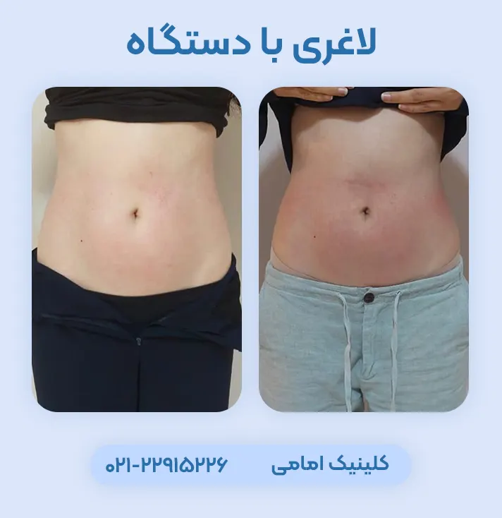 لاغری با آر اف