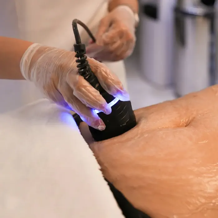 لاغری موضعی با RF