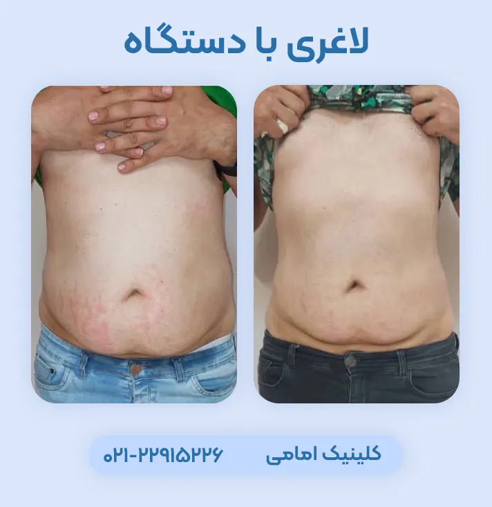 لاغری موضعی با RF