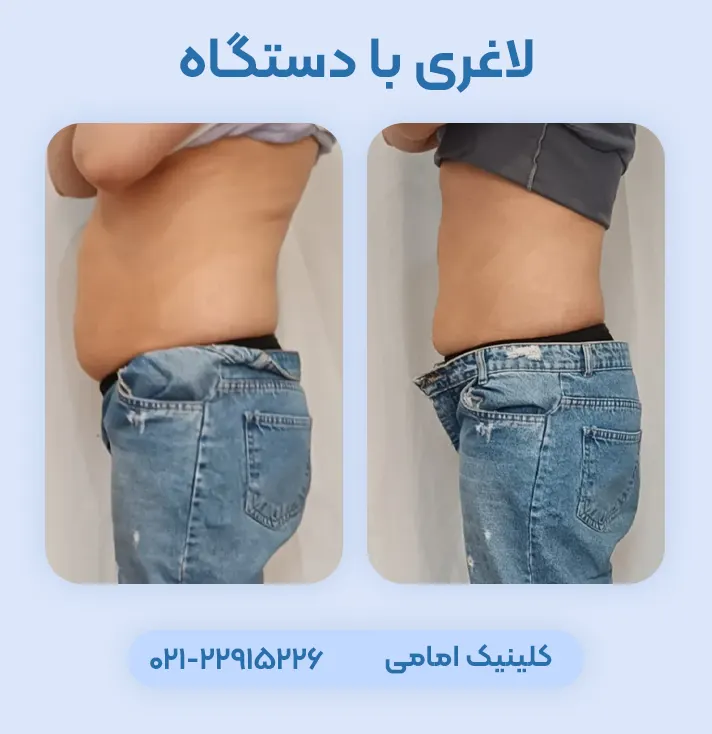 لاغری با آر اف