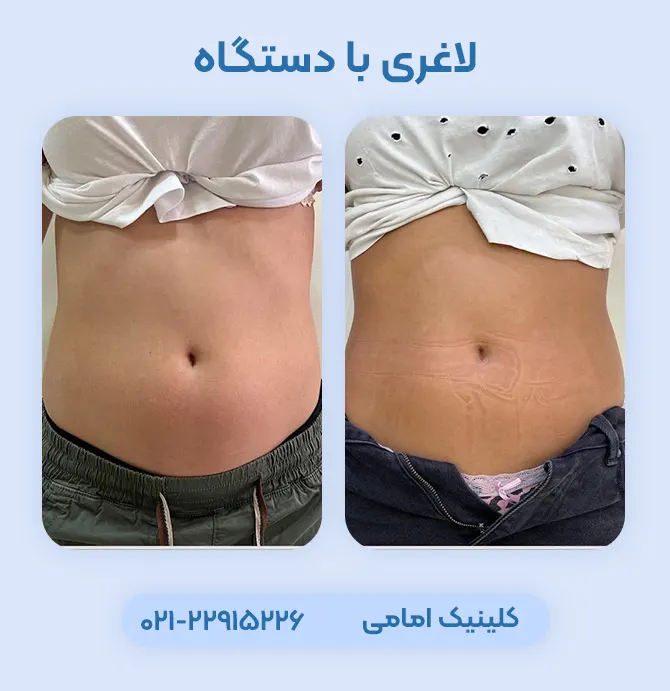 لاغری با دستگاه