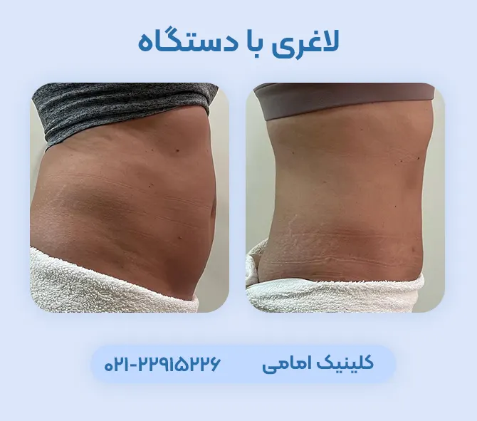 لاغری با دستگاه