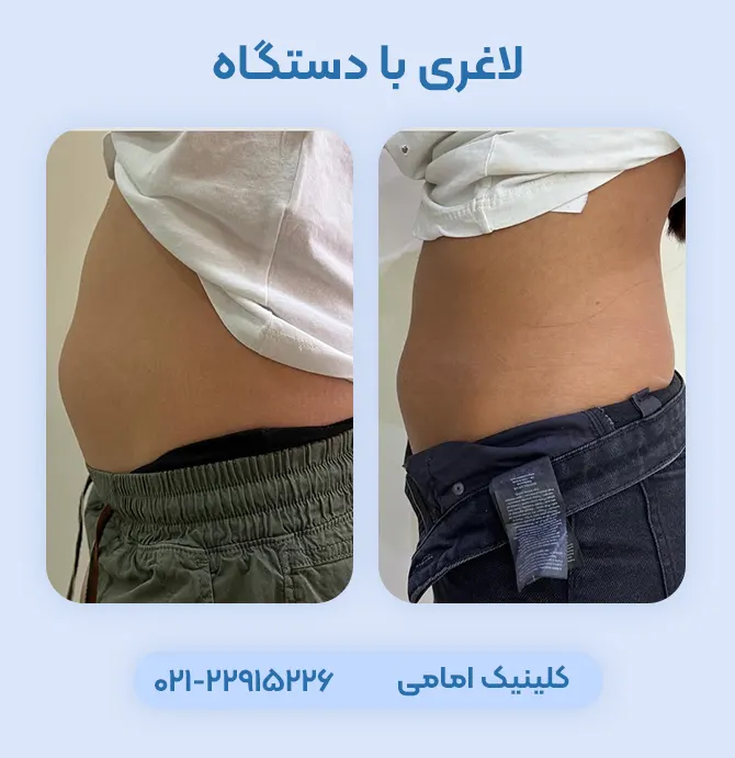 لاغری با دستگاه