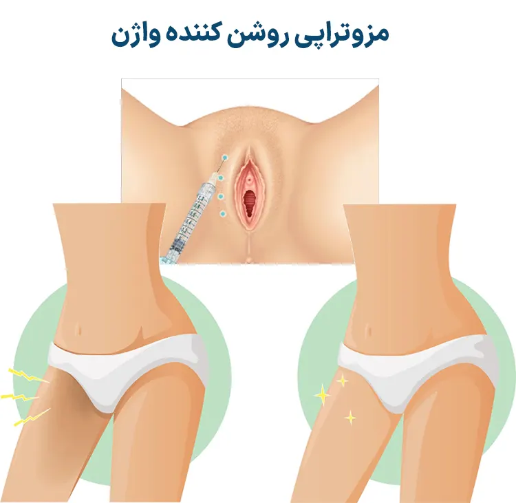 مزوتراپی روشن کننده واژن