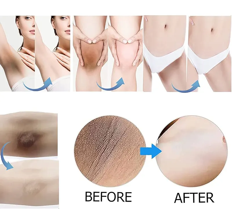 مزوتراپی رفع تیرگی واژن