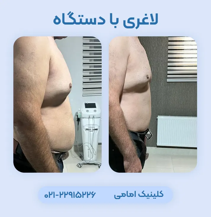 لاغری با دستگاه