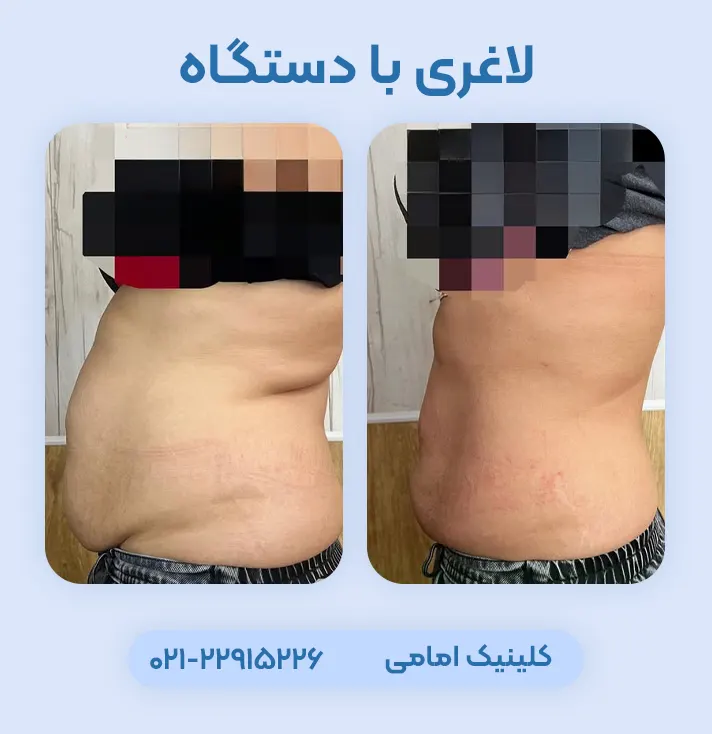 لاغری با دستگاه