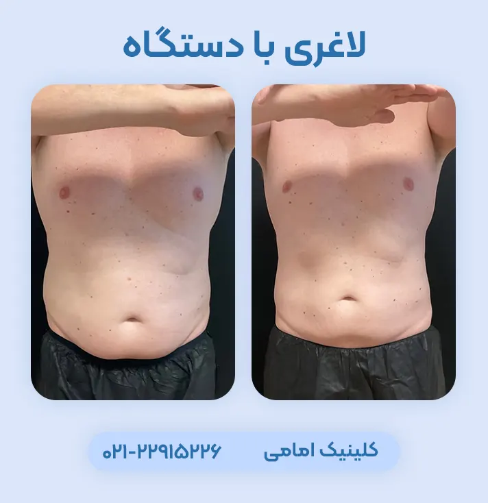 لاغری با دستگاه