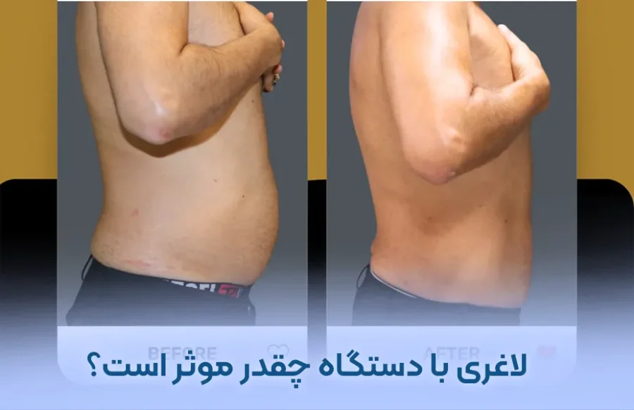 لاغری با دستگاه