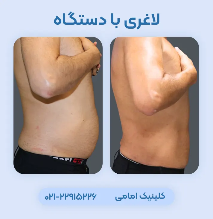 لاغری با دستگاه