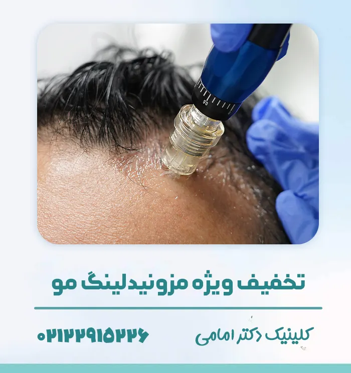 هزینه مزونیدلینگ مو