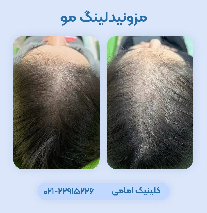 مزونیدلینگ مو