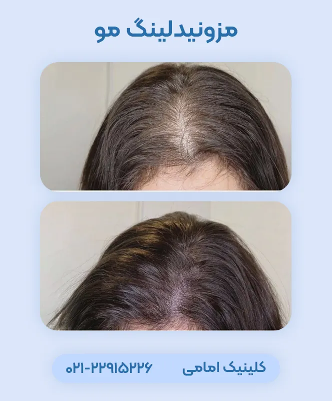 مزونیدلینگ مو