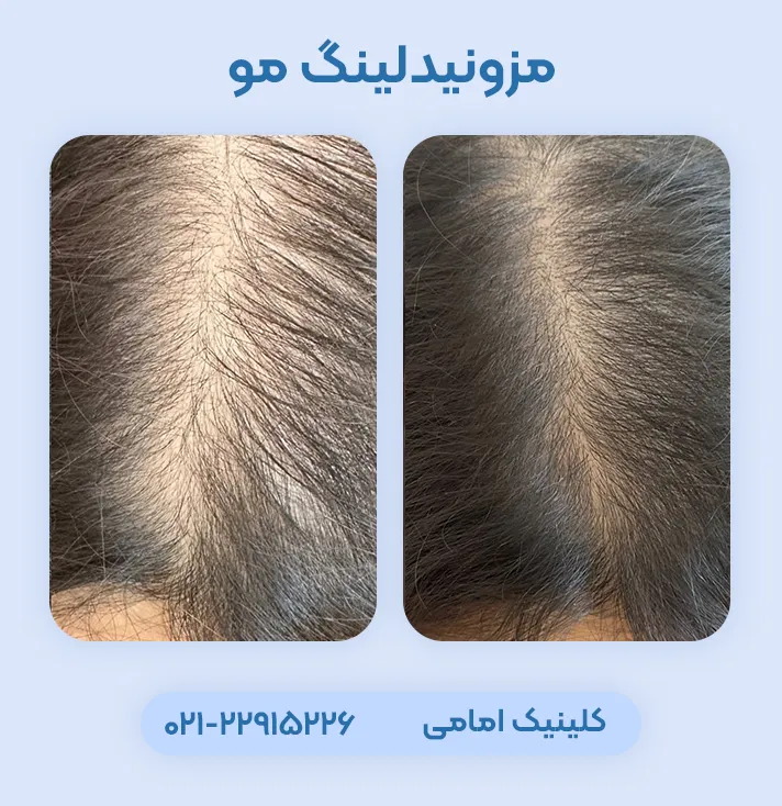 مزونیدلینگ مو