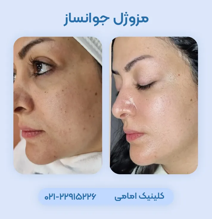 مزوژل کره ای