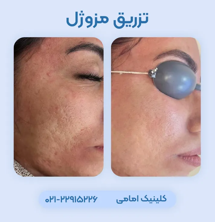 تزریق مزوژل جوانساز