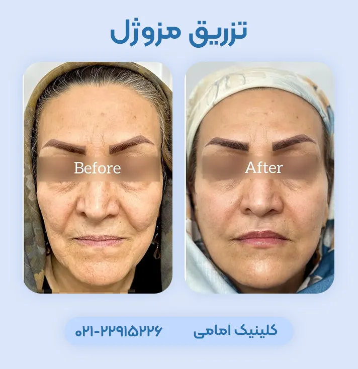 تزریق مزوژل قبل بعد