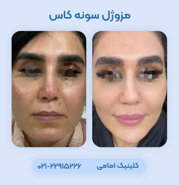 مزوژل سونه کاس