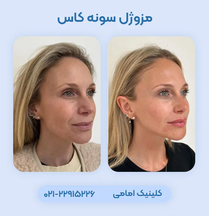 مزوژل سونه کاس