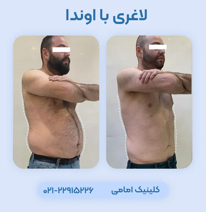 لاغری با دستگاه اوندا