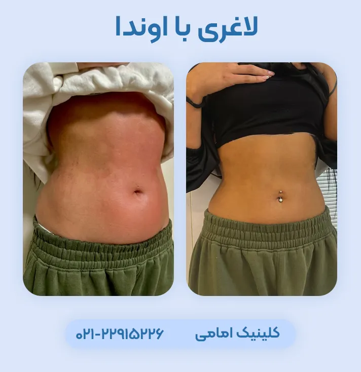 لاغری با دستگاه اوندا