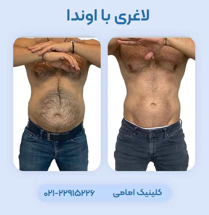 لاغری با دستگاه اوندا