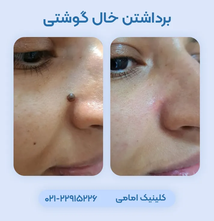 برداشتن خال گوشتی صورت