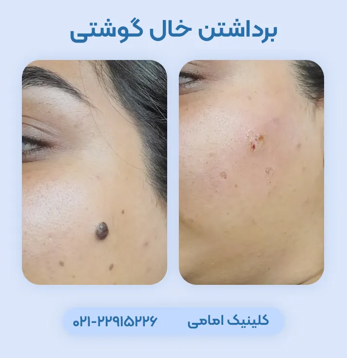 برداشتن خال گوشتی صورت