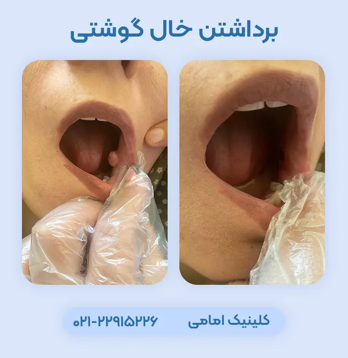 برداشتن خال گوشتی دهان