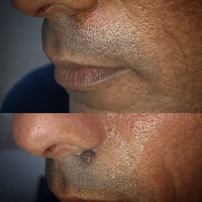 برداشتن خال گوشتی صورت