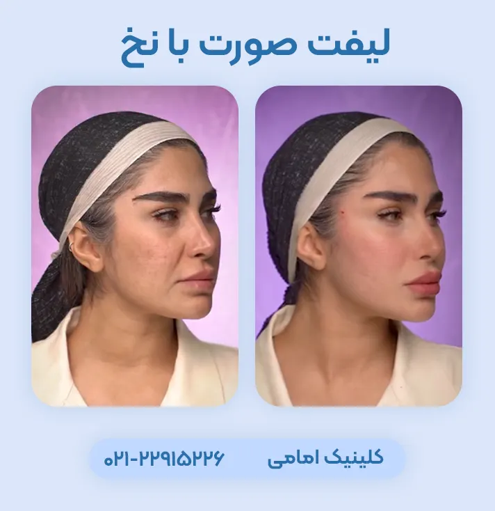 لیفت صورت با نخ