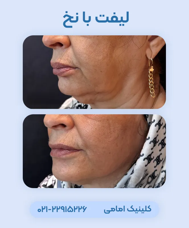 لیفت صورت با نخ