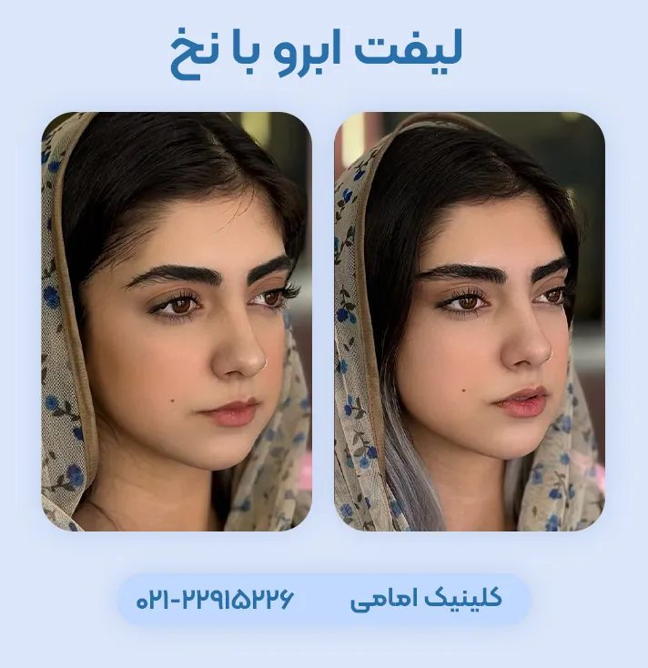 لیفت ابرو با نخ