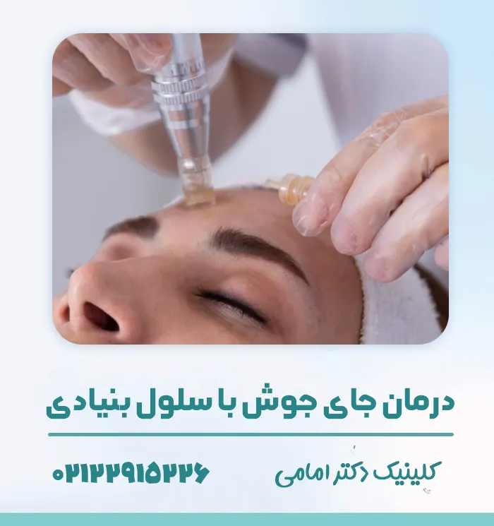 درمان جای جوش با سلول بنیادی