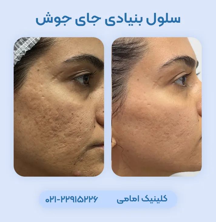 درمان جای جوش با سلول بنیادی