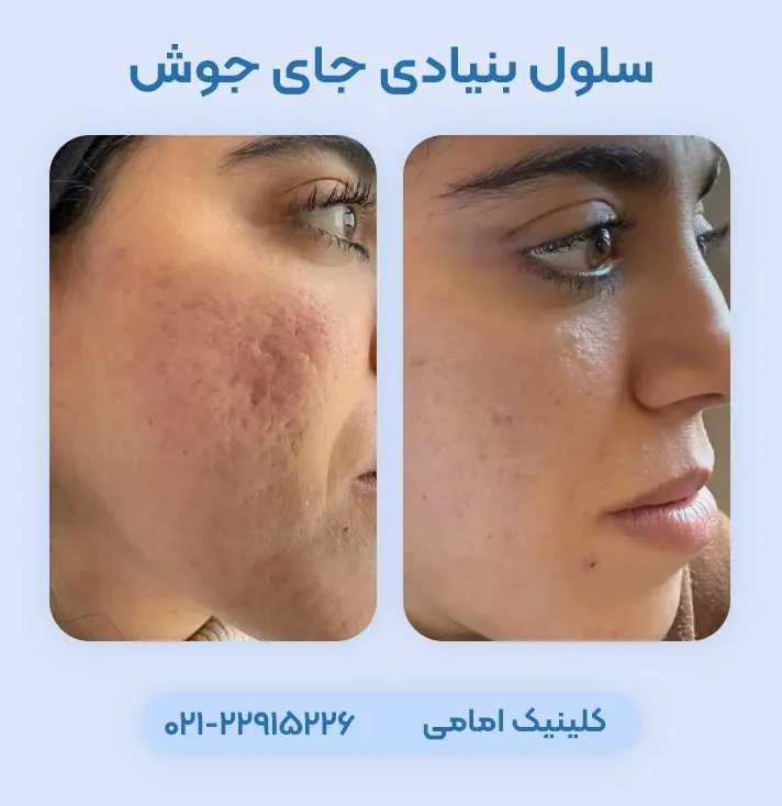 درمان جای جوش با سلول بنیادی