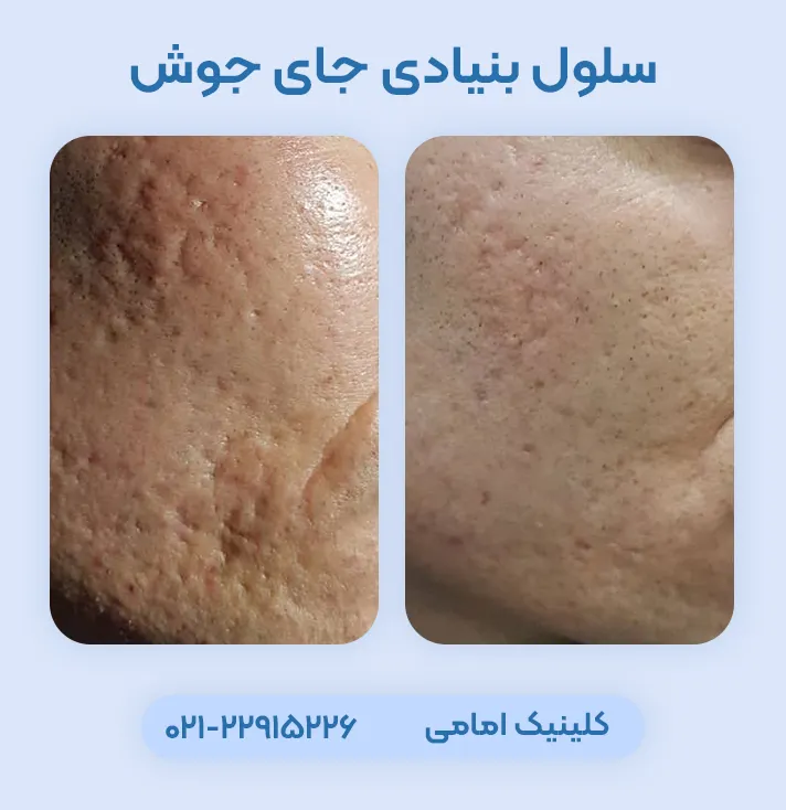 درمان جای جوش با اگزوزوم