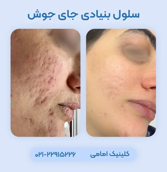 درمان اسکار آکنه با سلول بنیادی