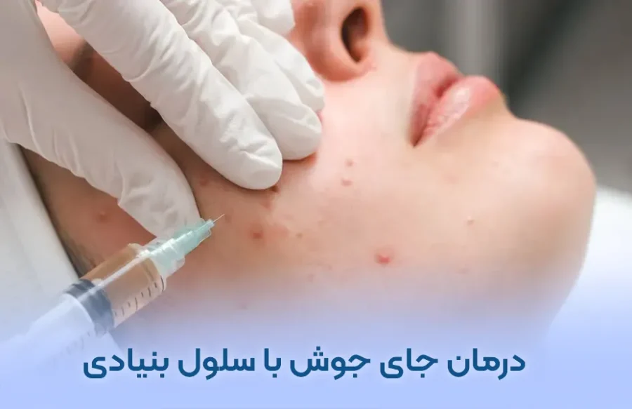 درمان جای جوش با سلول بنیادی