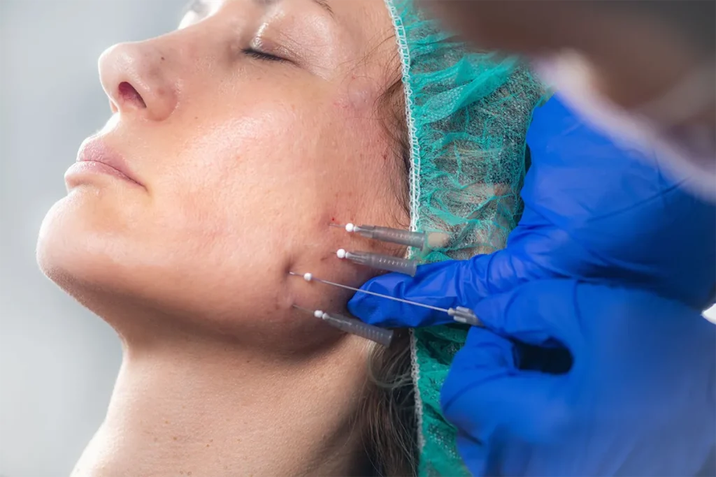 لیفت صورت با نخ