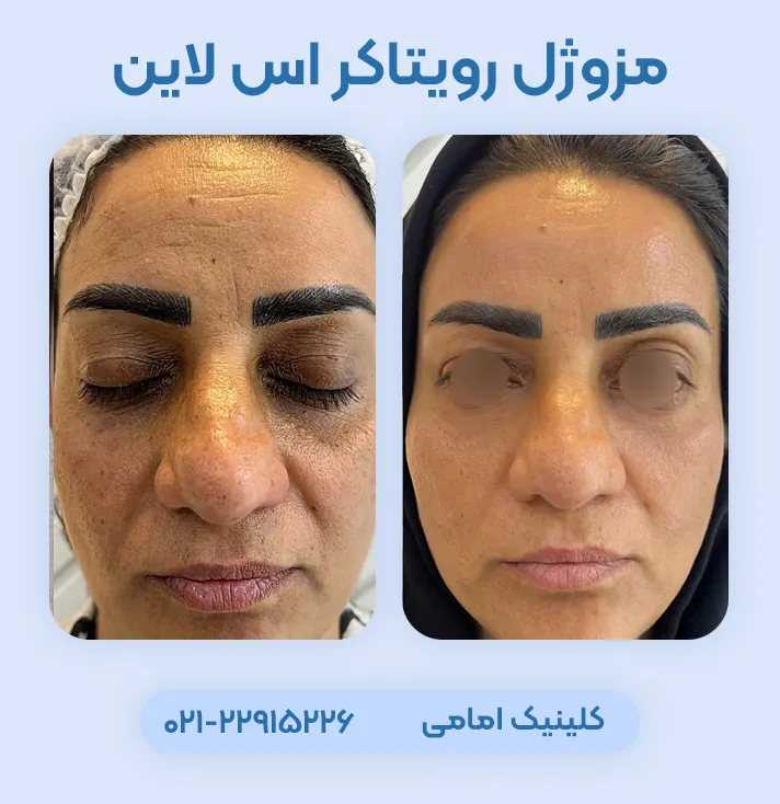 مزوژل رویتاکر اس لاین