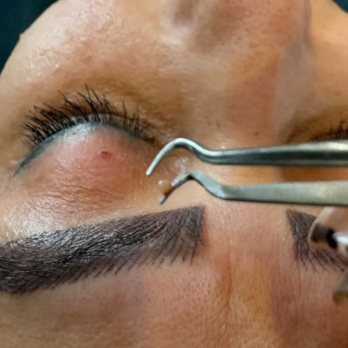 درمان میلیا صورت