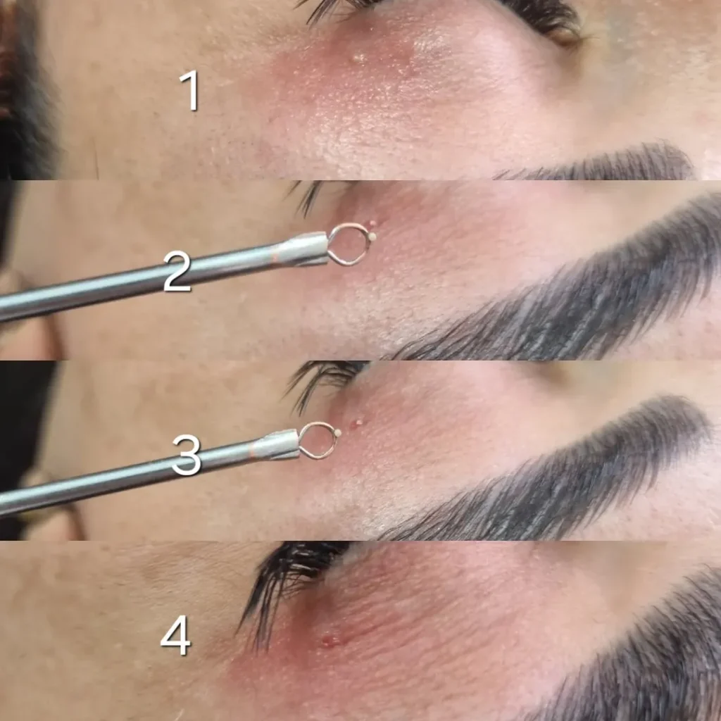 میلیا صورت و درمان