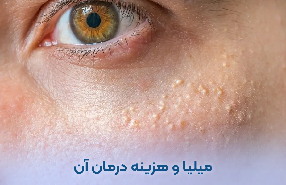 میلیا صورت و نحوه درمان آن + فیلم و هزینه درمان