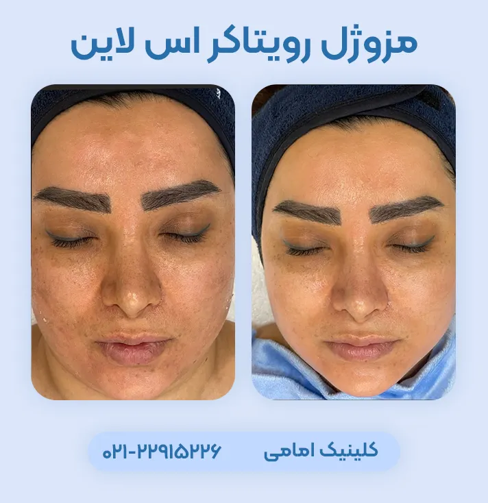 مزوژل رویتاکر اس لاین