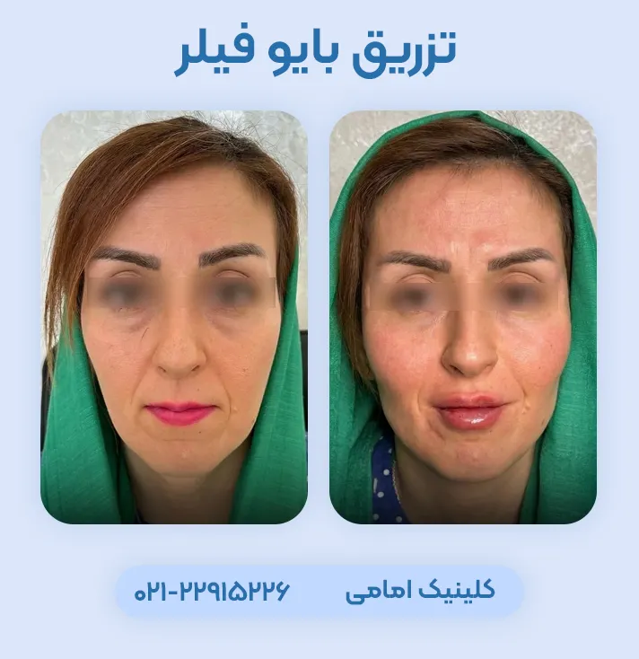 قبل بعد تزریق بایوفیلر