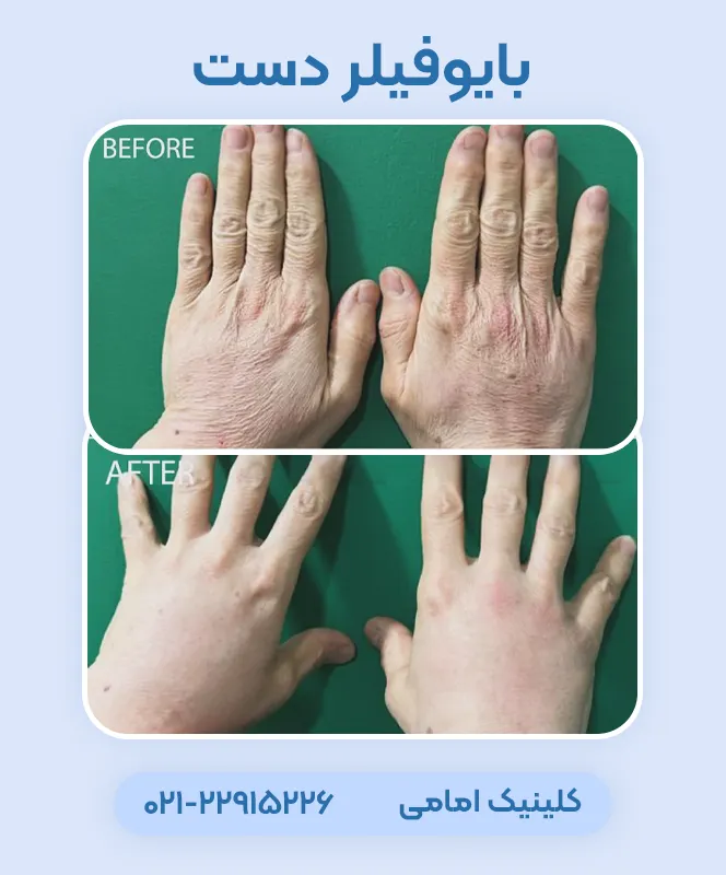  تزریق بایوفیلر برای دست
