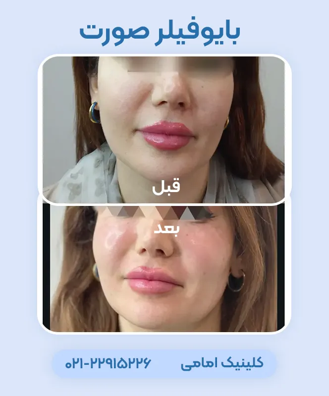 قبل بعد تزریق بایوفیلر
