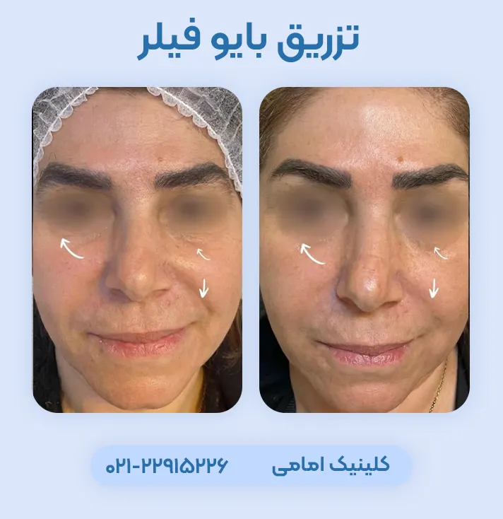 قبل بعد تزریق بایوفیلر